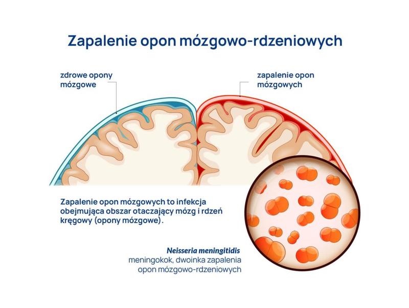 Objawy zapalenia opon mózgowych u niemowląt