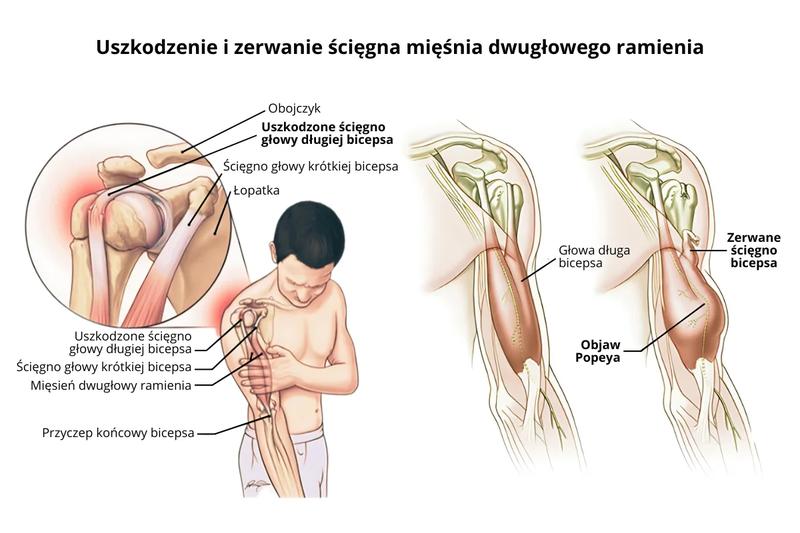 Pierwsza pomoc po urazie dłoni